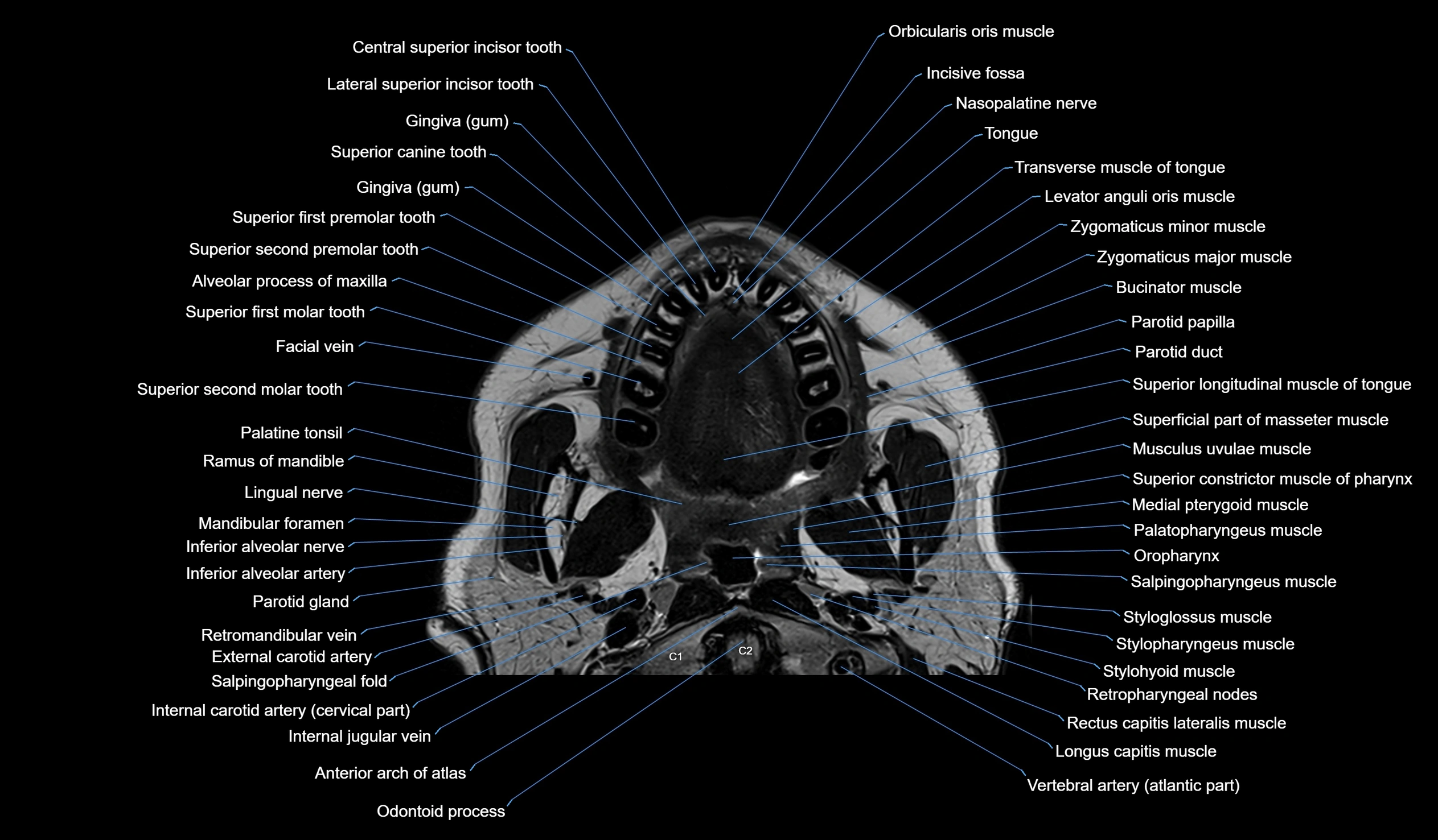 MRI face & paranasal sinuses(PNS) labelled  coronal  cross sectional anatomy 3T radiology  image-img-00001-00001.webp